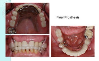 Final Prosthesis
 