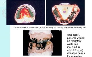 Final ORPD
patterns waxed
on refractory
casts and
mounted in
articulator; (a)
retention beads
Occlusal views of mandibular (A) and maxillary (B) overlay wax-ups on refractory cast.
 