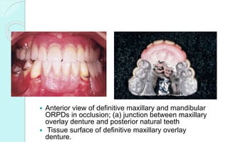  Anterior view of definitive maxillary and mandibular
ORPDs in occlusion; (a) junction between maxillary
overlay denture and posterior natural teeth
 Tissue surface of definitive maxillary overlay
denture.
 
