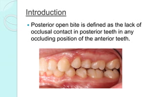 Introduction
 Posterior open bite is defined as the lack of
occlusal contact in posterior teeth in any
occluding position of the anterior teeth.
 