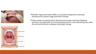 Flap versus flapless alveolar ridge preservation: A clinical and ...