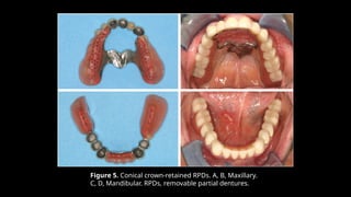Mandiblar Rpd Clinical Evaluation and Rehabilitation Using Conical Crown-Retained ...