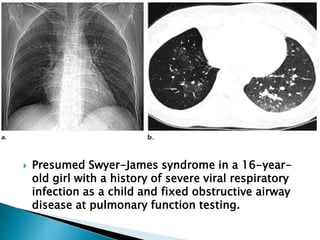  Presumed Swyer-James syndrome in a 16-year-
old girl with a history of severe viral respiratory
infection as a child and fixed obstructive airway
disease at pulmonary function testing.
 