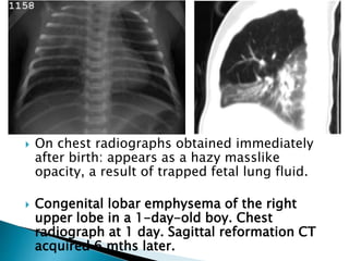  On chest radiographs obtained immediately
after birth: appears as a hazy masslike
opacity, a result of trapped fetal lung fluid.
 Congenital lobar emphysema of the right
upper lobe in a 1-day-old boy. Chest
radiograph at 1 day. Sagittal reformation CT
acquired 6 mths later.
 