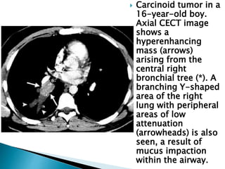  Carcinoid tumor in a
16-year-old boy.
Axial CECT image
shows a
hyperenhancing
mass (arrows)
arising from the
central right
bronchial tree (*). A
branching Y-shaped
area of the right
lung with peripheral
areas of low
attenuation
(arrowheads) is also
seen, a result of
mucus impaction
within the airway.
 