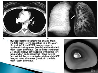  Mucoepidermoid carcinoma arising from
the left main-stem bronchus in a 15-year-
old girl. (a) Axial CECT image shows a
hyperenhancing mass (arrow) within the left
main-stem bronchus. (b) Volume-rendered
CT image shows air trapping within the left
lung and an endobronchial filling defect
(arrow). (c) Reconstructed endobronchial CT
image shows the mass (*) within the left
main-stem bronchus.
 