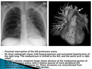  Proximal interruption of the left pulmonary artery
 PA chest radiograph shows mild hyperexpansion and associated hyperlucency of
the right lung. The mediastinum is shifted to the left, and the aortic arch is right
sided.
 (b) CECT volume-rendered image shows absence of the mediastinal portion of
the left pulmonary artery, with a relative paucity of more peripheral left
pulmonary arterial structures (*). These structures are reconstituted from
collateral vessels, including a PDA (arrow).
 