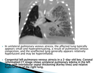  In unilateral pulmonary venous atresia, the affected lung typically
appears small and hyperattenuating, a result of pulmonary venous
congestion, and the unaffected lung generally appears relatively
hyperlucent and may be hyperinflated.
 Congenital left pulmonary venous atresia in a 2-day-old boy. Coronal
reformatted CT image shows unilateral pulmonary edema in the left
lung, with interlobular septal thickening (Kerley lines) and relative
hyperlucency of the right lung.
 