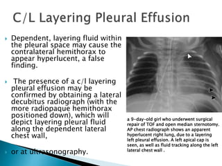  Dependent, layering fluid within
the pleural space may cause the
contralateral hemithorax to
appear hyperlucent, a false
finding.
 The presence of a c/l layering
pleural effusion may be
confirmed by obtaining a lateral
decubitus radiograph (with the
more radiopaque hemithorax
positioned down), which will
depict layering pleural fluid
along the dependent lateral
chest wall,
 or at ultrasonography.
a 9-day-old girl who underwent surgical
repair of TOF and open median sternotomy.
AP chest radiograph shows an apparent
hyperlucent right lung, due to a layering
left pleural effusion. A left apical cap is
seen, as well as fluid tracking along the left
lateral chest wall .
 