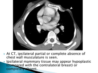  At CT, ipsilateral partial or complete absence of
chest wall musculature is seen.
 Ipsilateral mammary tissue may appear hypoplastic
(compared with the contralateral breast) or
completely absent.
 