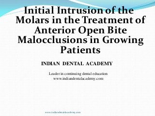 Initial Intrusion of the
Molars in the Treatment of
Anterior Open Bite
Malocclusions in Growing
Patients
www.indiandentalacademy.com
INDIAN DENTAL ACADEMY
Leader in continuing dental education
www.indiandentalacademy.com
 