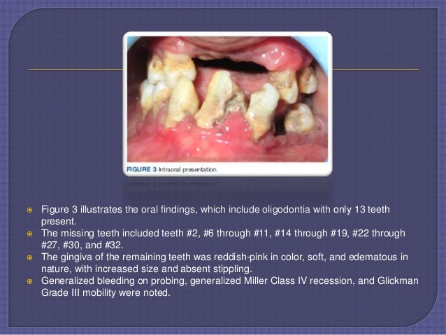 Fahr Syndrome- A Rare Case Report