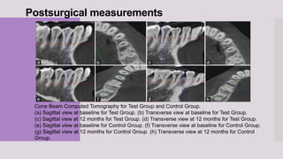 Postsurgical measurements
Cone Beam Computed Tomography for Test Group and Control Group.
(a) Sagittal view at baseline for Test Group. (b) Transverse view at baseline for Test Group.
(c) Sagittal view at 12 months for Test Group. (d) Transverse view at 12 months for Test Group.
(e) Sagittal view at baseline for Control Group. (f) Transverse view at baseline for Control Group.
(g) Sagittal view at 12 months for Control Group. (h) Transverse view at 12 months for Control
Group.
 