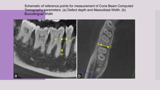 Schematic of reference points for measurement of Cone Beam Computed
Tomography parameters. (a) Defect depth and Mesiodistal Width. (b)
Buccolingual Width
 