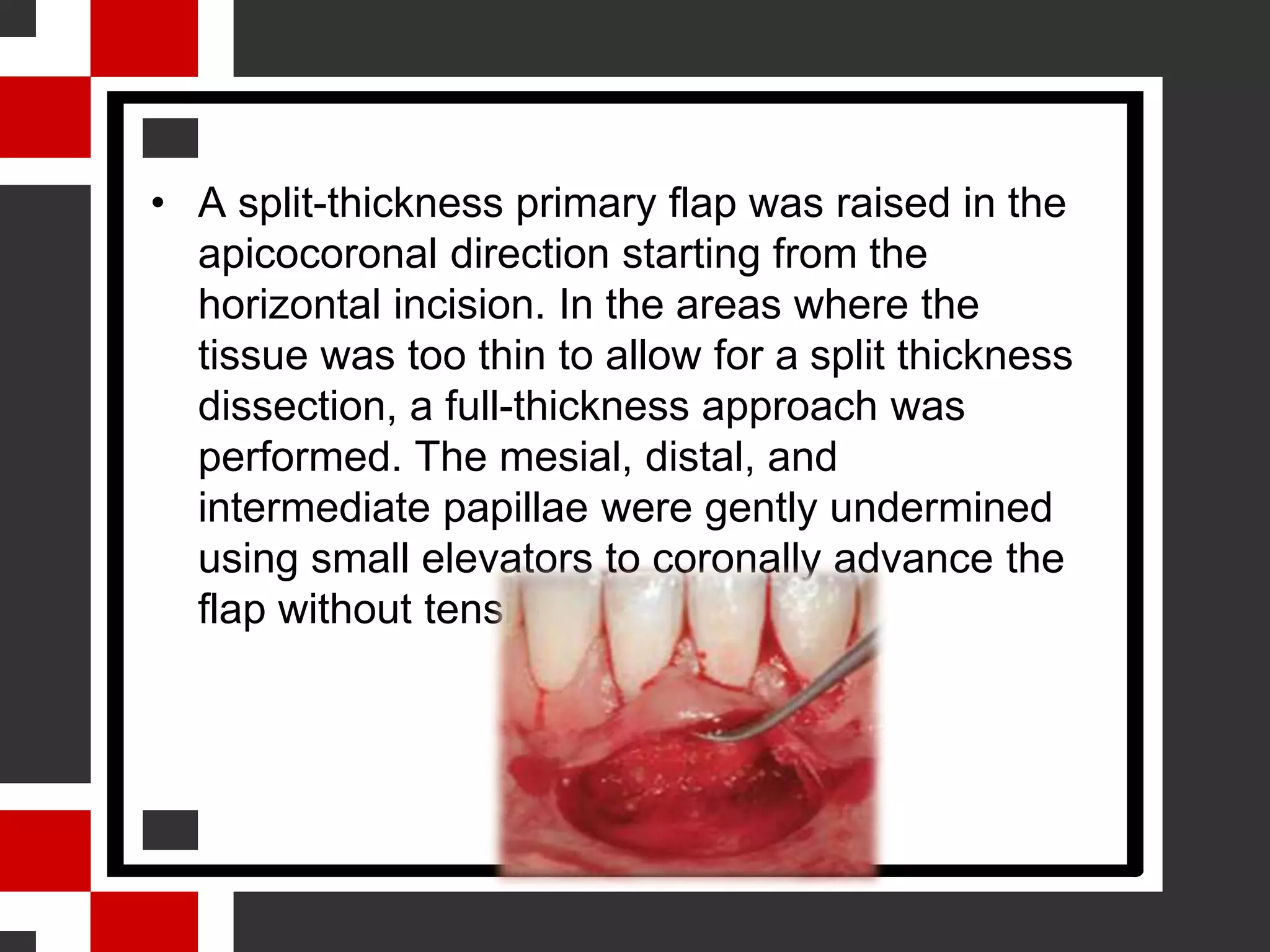 Journal club on A Mucogingival Technique for the Treatment of Multiple ...
