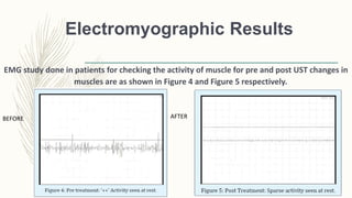 Electromyographic Results
EMG study done in patients for checking the activity of muscle for pre and post UST changes in
muscles are as shown in Figure 4 and Figure 5 respectively.
BEFORE AFTER
 