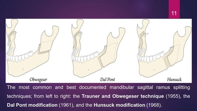 Journal Club Bad splits in bilateral sagittal split osteotomy ...