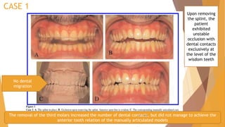 CASE 1
No dental
migration
The removal of the third molars increased the number of dental contacts, but did not manage to achieve the
anterior tooth relation of the manually articulated models
Upon removing
the splint, the
patient
exhibited
unstable
occlusion with
dental contacts
exclusively at
the level of the
wisdom teeth
22-11-2020 18
 