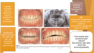 unstable
occlusion
and the
absence of
anterior
guidance in
lateral
movements.
bilateral
condylar
Hypoplasia in
OPG
MRI
verified disk displacement
without reduction, with
moderate
osteoarthritic changes and
edema in left TMJ
stabilization
splint was fitted
for part-time
use, not
necessarily
limited to
nocturnal use
Five months later
occasional pain
reduced
But anterior open bite,
which had
occurred gradually22-11-2020 22
 