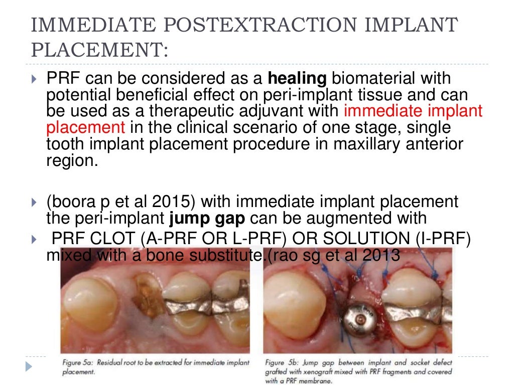 Introduction to Platelet Rich Fibrin (PRF) and its uses in Dentistry