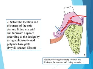 2. Select the location and
thickness of the soft
denture lining material
and fabricate a spacer
according to the design by
using a photoactivated
polymer base plate
(Physio-spacer; Nissin)
Spacer providing necessary location and
thickness for denture soft lining material.13
 