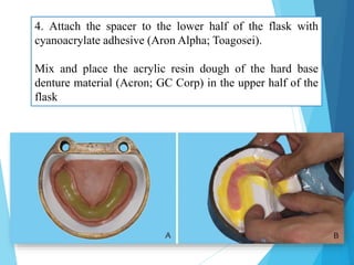 4. Attach the spacer to the lower half of the flask with
cyanoacrylate adhesive (Aron Alpha; Toagosei).
Mix and place the acrylic resin dough of the hard base
denture material (Acron; GC Corp) in the upper half of the
flask
16
 