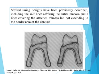 Several lining designs have been previously described,
including the soft liner covering the entire mucosa and a
liner covering the attached mucosa but not extending to
the border area of the denture
Metal reinforced silicone-lined dentures. Morrow RM, Reiner PR, Feldmann EE, Rudd KD: JPD 1968
Mar;19(3):219-29.
23
 