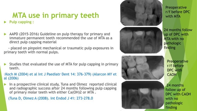 MTA USE IN PEDIATRIC DENTISTRY: LITERATURE REVIEW