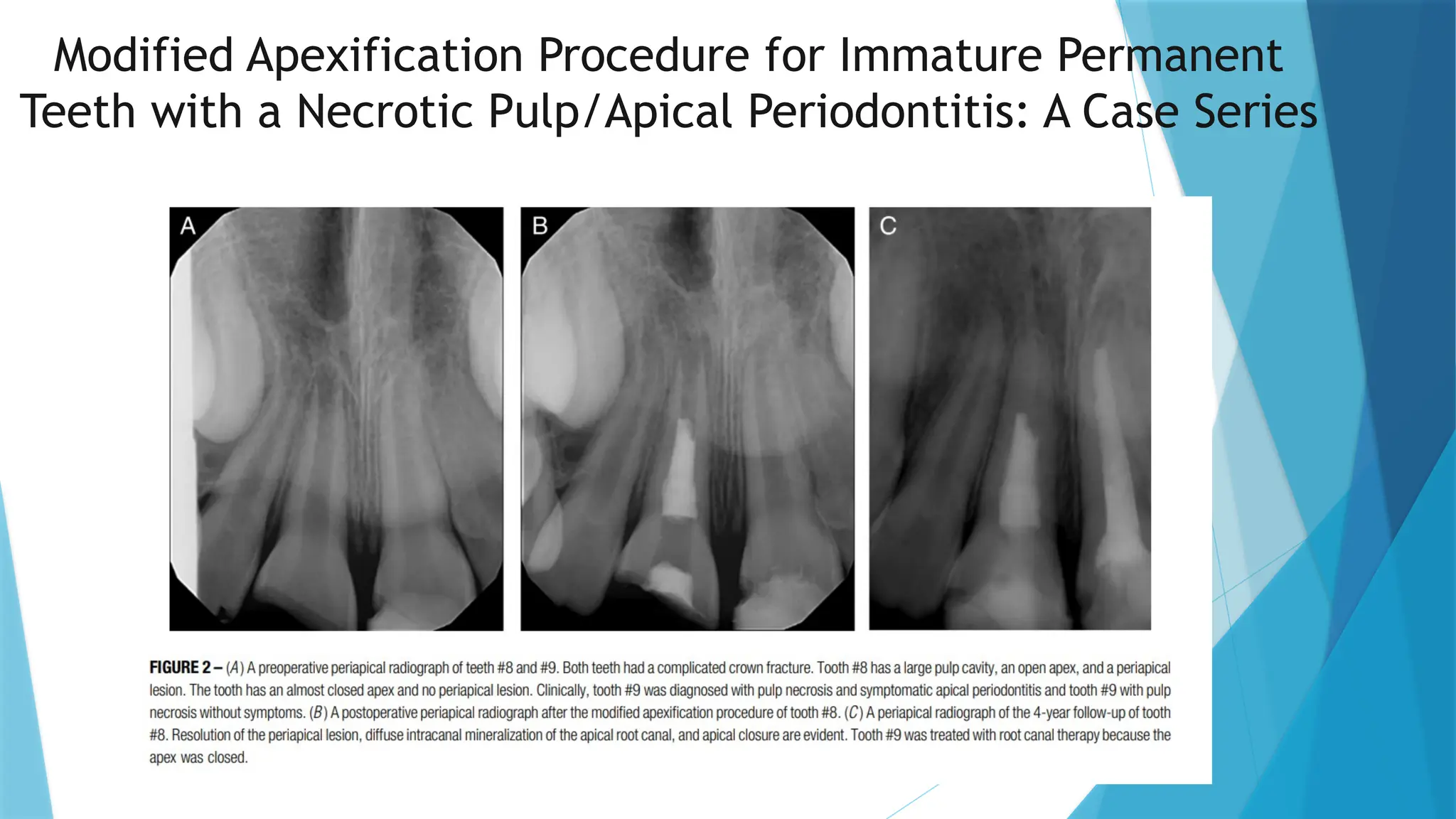 Modified Apexification Procedure for Immature Permanent
Teeth with a Necrotic Pulp/Apical Periodontitis: A Case Series
 
