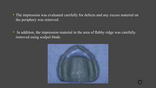 Flared Ridge managemnet of the flabby ridge using a modified technique.pptx
