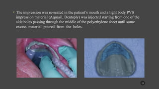 Flabby Ridge Radiograph managemnet of the flabby ridge using a modified technique.pptx