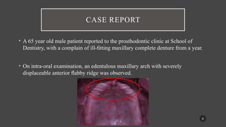 Flabby Ridge Radiograph managemnet of the flabby ridge using a modified technique.pptx