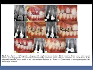 Extruded Teeth orthodontic extrusion of endodonticteeth | PPTX