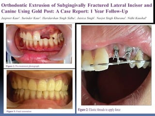 Extruded Teeth orthodontic extrusion of endodonticteeth | PPTX