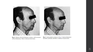 clinical measurement and evaluation of vertical dimension.pptx