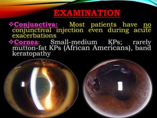 jCA-uveitis 2 [Autosaved].pptx