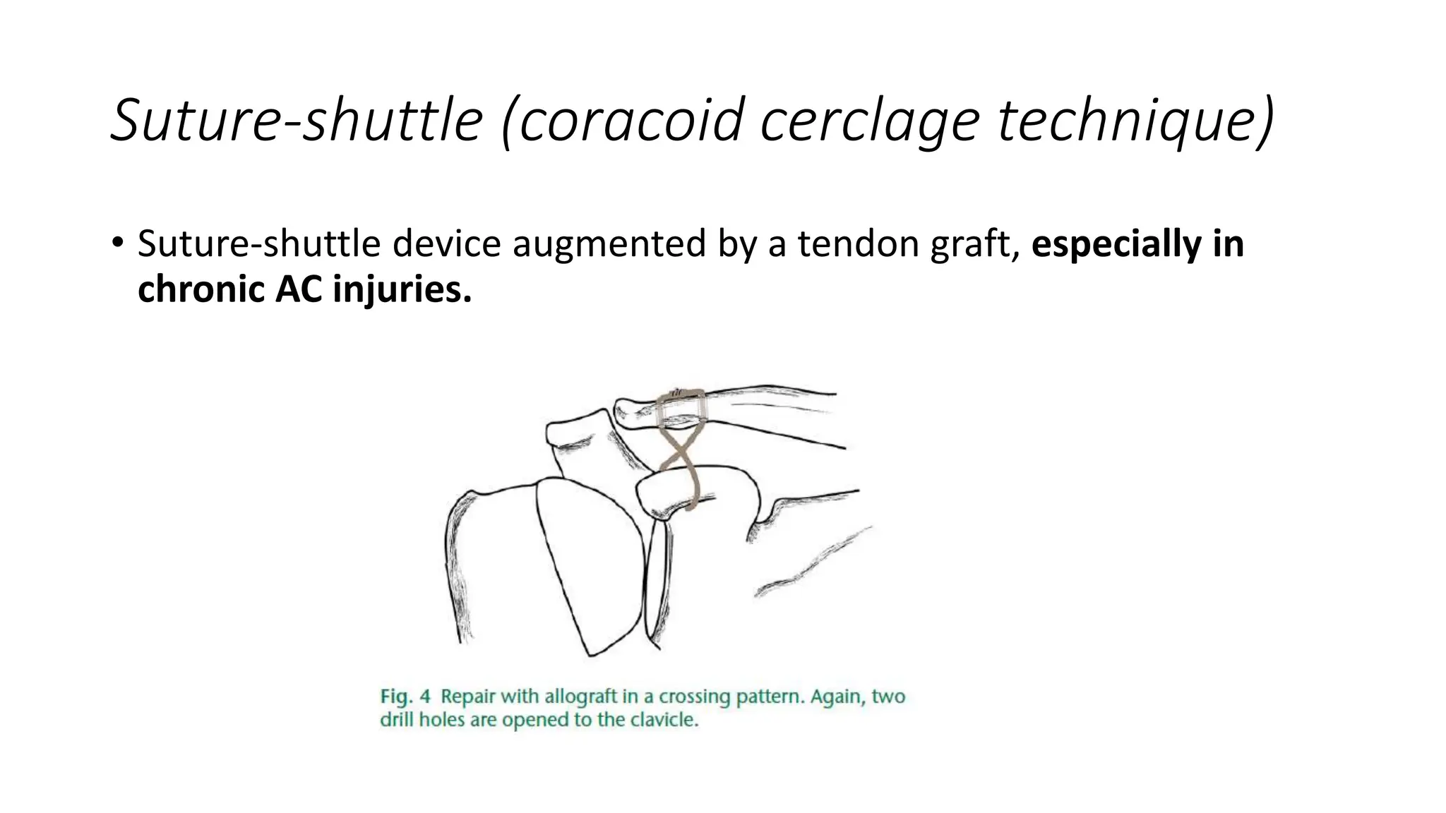 JC Acromioclavicular joint injuries.pptx