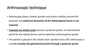 Arthroscopic technique
• Arthroscopy allows a better, greater and clearer visibility around the
coracoid, and extensive dissection of the deltotrapezial fascia is not
required.
• 3 portals are mainly used: namely a posterior portal; an anterolateral
portal for the optical device; and an operative anterosuperior portal.
• The patient is placed in the ‘beach-chair’ position and a 30° arthroscope is
used to visualize the glenohumeral joint through a posterior portal.
 