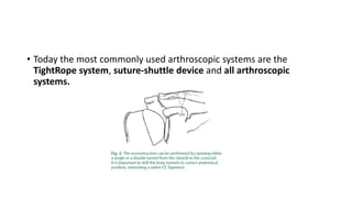 • Today the most commonly used arthroscopic systems are the
TightRope system, suture-shuttle device and all arthroscopic
systems.
 