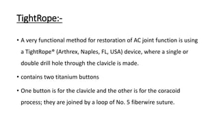 TightRope:-
• A very functional method for restoration of AC joint function is using
a TightRope® (Arthrex, Naples, FL, USA) device, where a single or
double drill hole through the clavicle is made.
• contains two titanium buttons
• One button is for the clavicle and the other is for the coracoid
process; they are joined by a loop of No. 5 fiberwire suture.
 