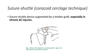 Suture-shuttle (coracoid cerclage technique)
• Suture-shuttle device augmented by a tendon graft, especially in
chronic AC injuries.
 