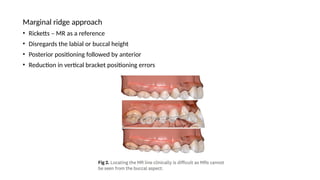 JC Bracket positioning in orthodontics.pptx