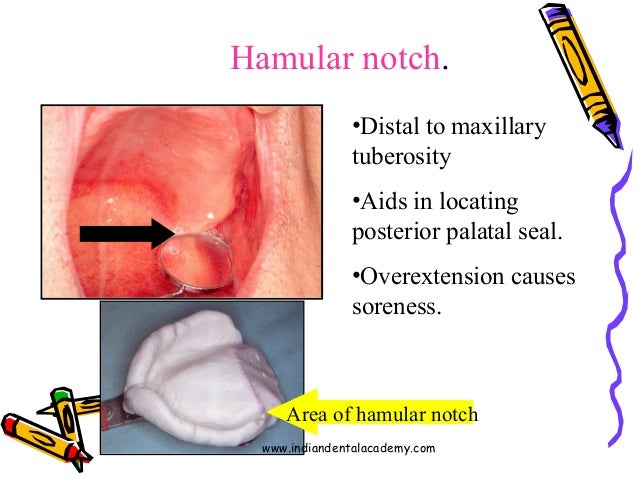 hamular notch