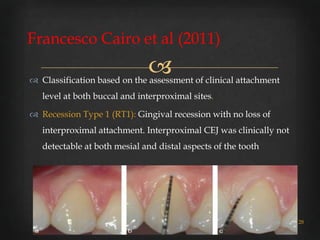 Gingival recession classifications | PPTX