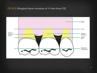 Gingival recession classifications | PPTX