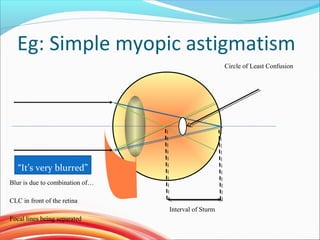 Eg: Simple myopic astigmatism
Interval of Sturm
Circle of Least Confusion
Blur is due to combination of…
CLC in front of the retina
Focal lines being separated
“It’s very blurred”
 