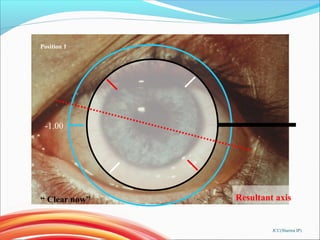 Position 1
Resultant axis
-1.00
JCC(Sharma IP)
“ Clear now”
 