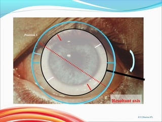 Resultant axis
Position 1
JCC(Sharma IP)
 