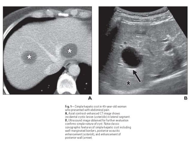 Cystic hepatic lesions