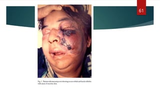 JC Fungal Infection.pptx oral and maxillofacial surgery | PPTX